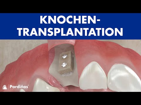 Knochentransplantation ©