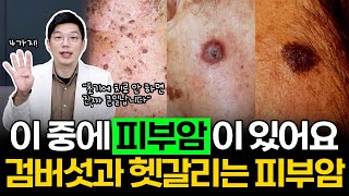 검버섯과 가장 많이 헷갈리는 피부암! 지금 내 얼굴에 있지는 않은지 살펴보세요