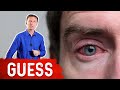 What Causes Bloodshot Eyes? – Dr.Berg