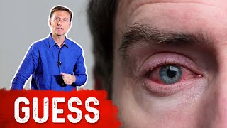 What Causes Bloodshot Eyes? – Dr.Berg