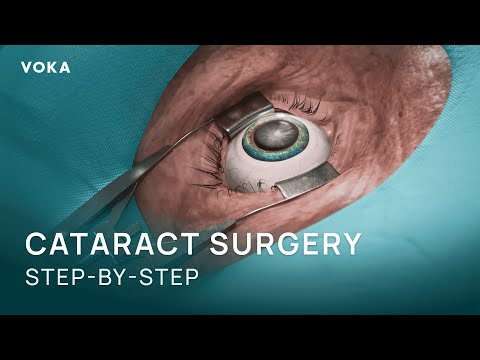 Cataract Surgery Explained in 3D: Phacoemulsification Step-by-Step