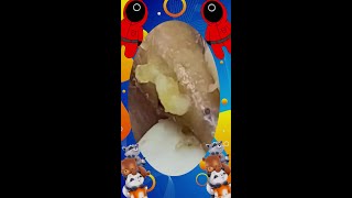 Download lagu Blackheads Removal | Acne Treatment and Very Satisfying Satisfying Pimple pop #blackheads mp3