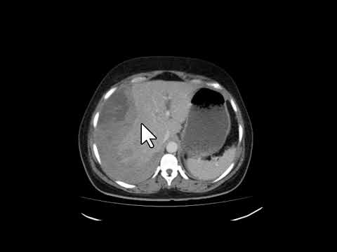 US e TC na rotura hepática espontânea secundária à síndrome HELLP