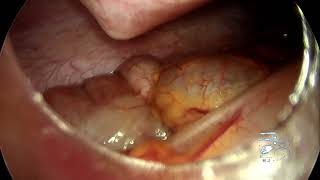 Laparoscopic Appendectomy – Step-by-Step Surgery | Acute Appendicitis Case