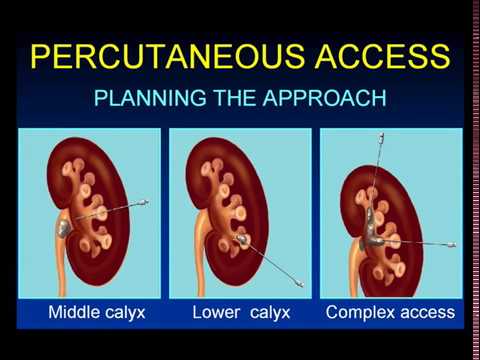 Innovations In Surgical Stone Management