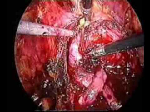 Lanalgesia in fase di cancro alla prostata 4 Prostata photo massaggio
