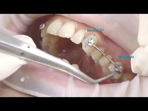 Carriere® Motion™  Class II Appliance Placement Video