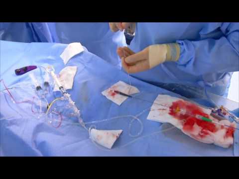 Acrostak ACROSS CTO, ACROSS HP, & M-CATH - CTO of proximal CX