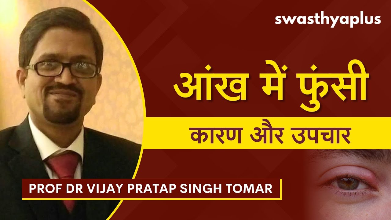आंख में फुंसी: कारण और उपचार | Stye/ Hordeolum: Treatment, Hindi | Prof Dr Vijay Pratap Singh To