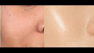 How to Get Crystal Clear Glowing Skin, Spotless Skin Tone | DeTan, Pimple Clean - SuperWowStyle