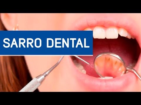 Qué es el sarro dental / Odontoespecialistas