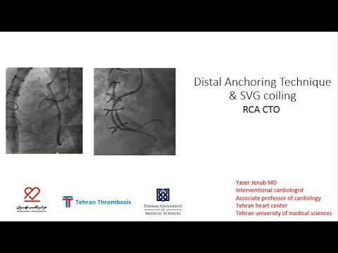 Distal Anchoring Technique and SVG coiling: CTO solutions