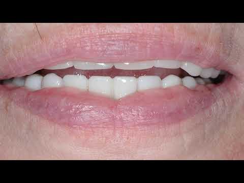 Patient Testimonial 14