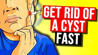 How to Get Rid of a Cyst in 2024
