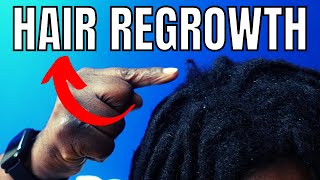 How to Grow Thinning Hair (1 Tip Everyone with Dreads NEEDS to Know!)