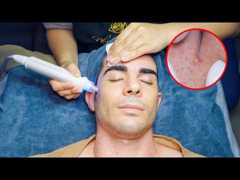 ASMR: Satisfying Acne Removal & Vacuum Facial Massage Treatment in Vietnam