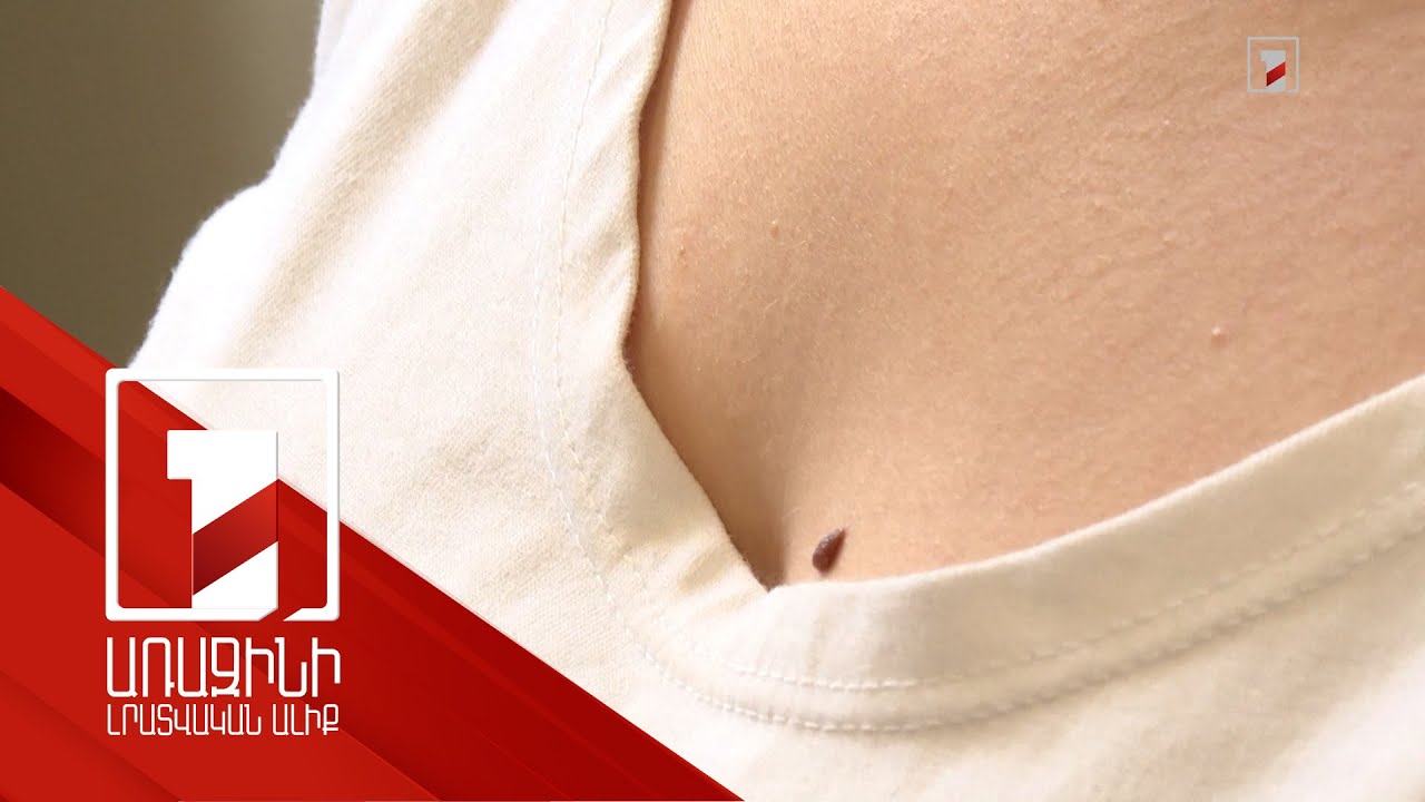 Վտանգավոր խալեր. մելանոմայի ռիսկ