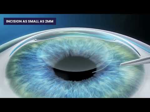 How does ZEISS SMILE® pro Laser Vision Correction work? | Myopia & Astigmatism | LSC Eye Clinic