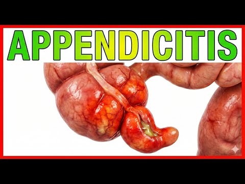 Appendicitis: Introduction, Pathogenesis, Cllinical features, Lab findings, Imaging, Management