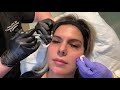 FEMALE FACIAL SCULPTING FOR SLIMMER, HEART-SHAPED FACE | CHEEK, TEMPLE, JAWLINE/CHIN | DR JASON EMER