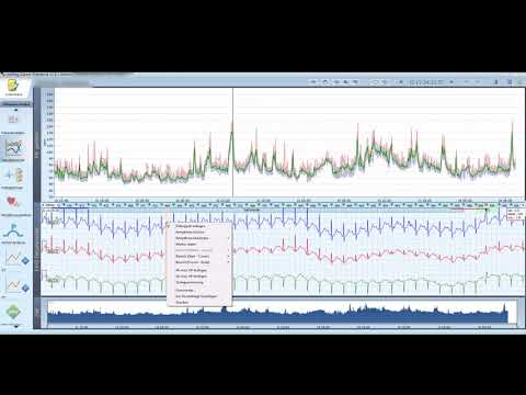 Einführung in die Auswertung eines Langzeit-EKGs mit Medilog Darwin 2