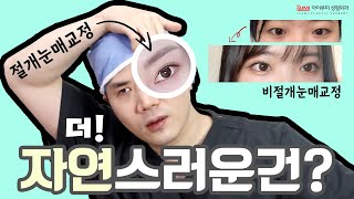 눈매교정 ????절개vs비절개 더 자연스럽고 예쁜건?