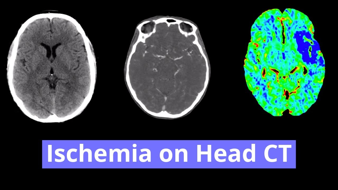 Ischemia on Head CT