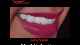 Hollywood Smile avant - après par Dr Amina El Omrani / New Smile Casablanca