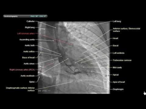 Normal Coronarography 