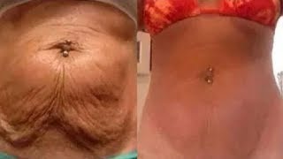 Haut am bauch