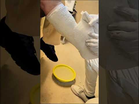 Как наложить гипс на стопу при переломах: пошаговое руководство для идеального заживления