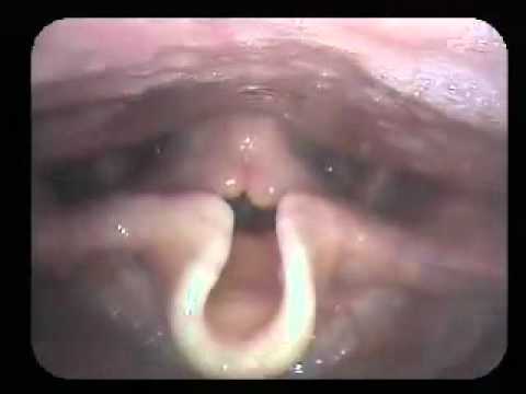 Laryngoscopy: Healthy male opera singer singing