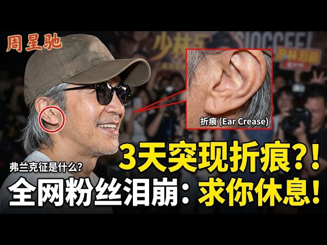 周星驰耳朵惊现“神秘折痕”？医学上叫弗兰克征！粉丝齐哭喊：求你别拼了！