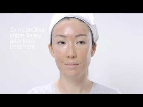 Professional Serum: The clinical protocol to using Professional Serum during and after a clinical laser treatment