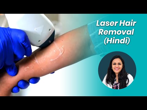 Laser Hair Removal (Hindi) | लेजर से बालों को हटाना | Before & After Results