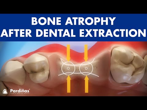 Bone atrophy after tooth extraction ©