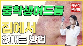 중학생 여드름 없애는 방법! 10대 청소년 여드름 생활습관으로 없애는 법