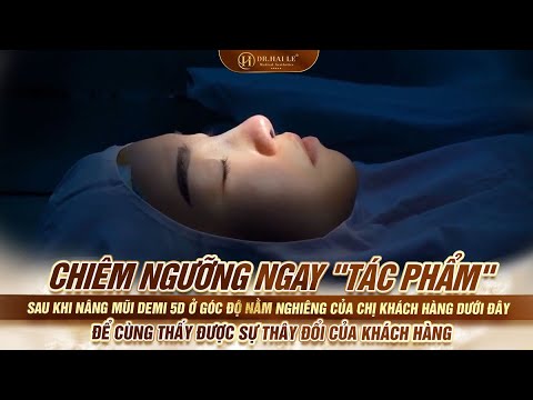 Nâng mũi Demi 5D ở góc độ nằm nghiêng dưới đây để cùng thấy được sự thây đổi của khách hàng