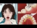 ASMR Dental Treatment Animation Satistfying Tartar Caries Removal Meng S Stop Motion