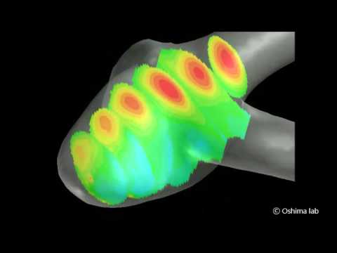 in vitro Stereoscopic-PIV measurement of Brain Aneurysm model