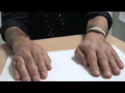 Mal di collo dà al braccio e girare la testa Previsione protesi totale danca