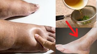 HOW TO GET RID OF WATER RETENTION ON YOUR FEET THE ALL NATURAL WAY.