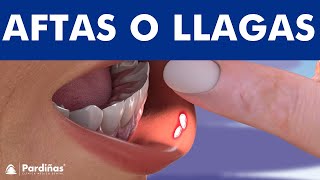 Afta bucal – Las llagas en la boca ©