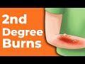 2nd Degree Burns: How to Treat Them | Wound Care OC