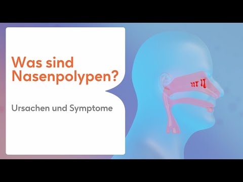 Was sind Nasenpolypen?