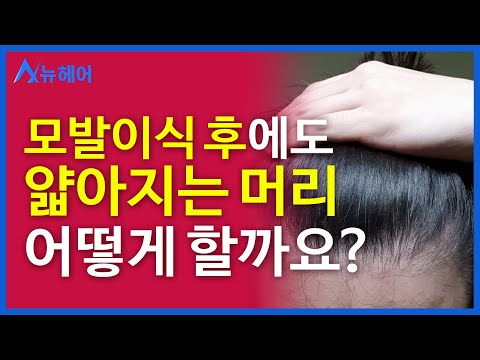 모발이식했지만, 다른 부위에 탈모가 옵니다. 어떡하죠?  l 우리끼리 탈밍아웃 l 뉴헤어