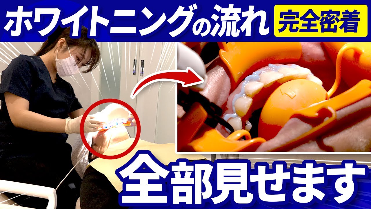 ホワイトニングの動画