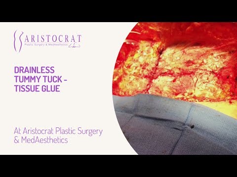 Drainless Tummy Tuck- Tissue Glue