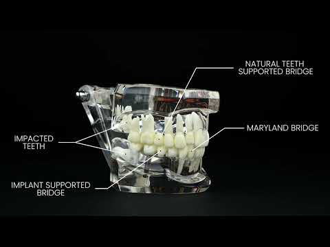 iDENTical Patient Education Model (Caries,implant,Nerves) M2001-3