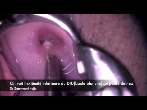 comment poser sterilet